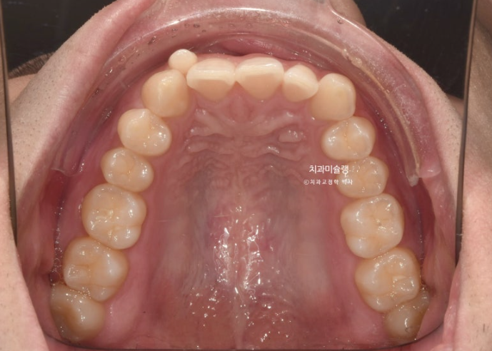 옥니 덧니 교정 왜소치 선천적 결손 3전치 무삭제 라미네이트 인비절라인 교정 관련 이미지 6