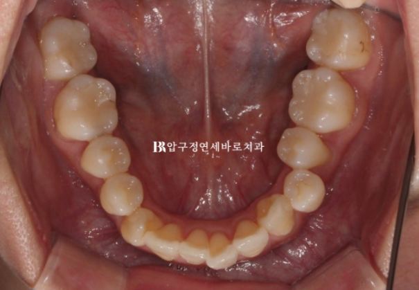 결혼식 6개월 전, 교정 시작해도 될까요? 관련 이미지 7