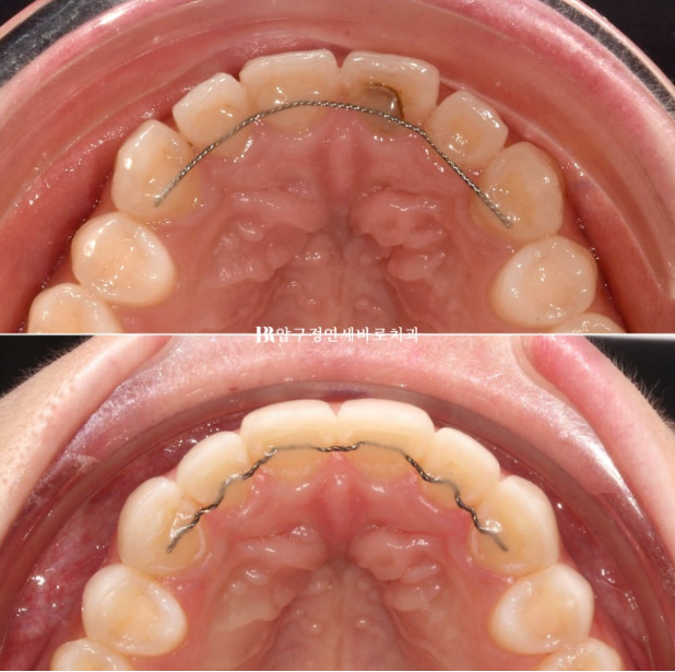 Before and After Non-Prep Veneers: Improving Gaps Between the Front Teeth and the Smile Line Together image 10