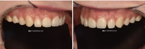 Non-Prep Veneer Review | A Case Naturally Improving Gaps Between the Front Teeth and the Smile Line image 2