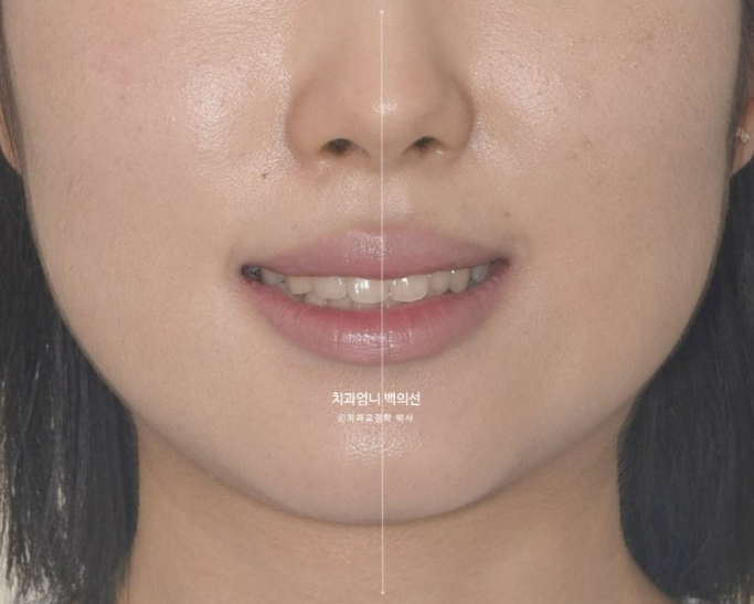 인비절라인 교정 비발치 비대칭 덧니 중심선 선천적 결손치 교정? 관련 이미지 3