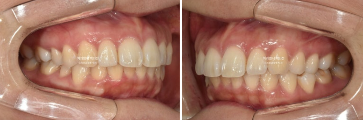 30대 돌출입 발치교정 입술부전증 치료 관련 이미지 3
