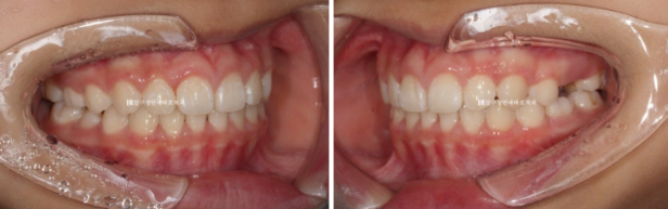 압구정 어린이교정 인비절라인 퍼스트 악궁확장 덧니 교정 관련 이미지 8