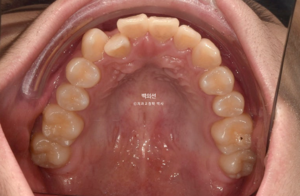 유학생 교정 덧니 반대교합 인비절라인 라이트 치료기간 관련 이미지 4