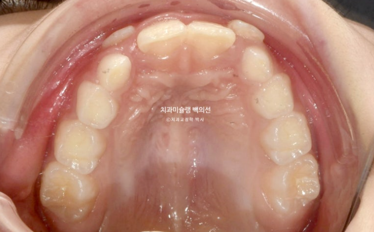 어린이 무턱 성장교정 덧니 인비절라인 퍼스트 악궁확장 치료기간 2년 관련 이미지 4