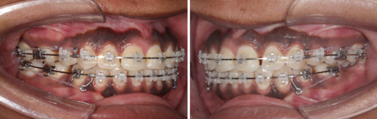 Extraction & re-orthodontics with Clippy-C, intrusion for dental implant. 관련 이미지 9