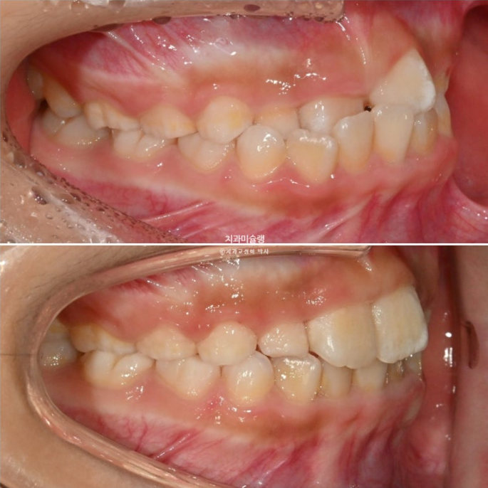 7세 어린이 반대교합 부정교합 프리올소 치료 관련 이미지 10