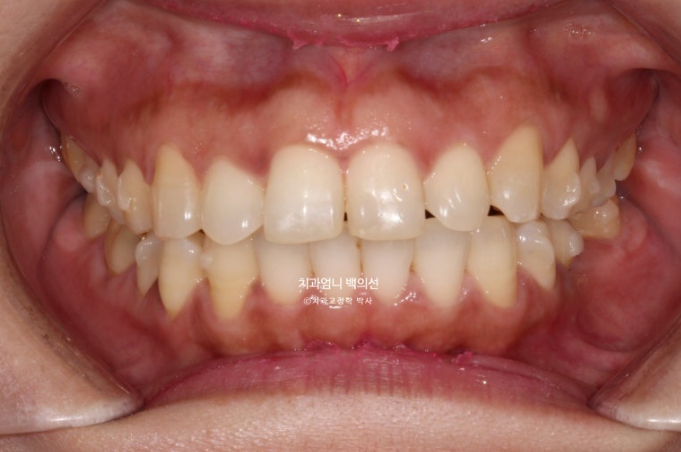 40대 인비절라인 라이트 앞니 벌어짐 뻗침 돌출 치료 관련 이미지 7