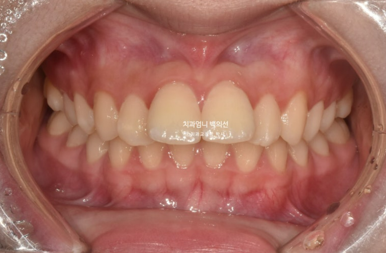 입이 안 다물어짐 입술부전증 호두턱 교정? 관련 이미지 2