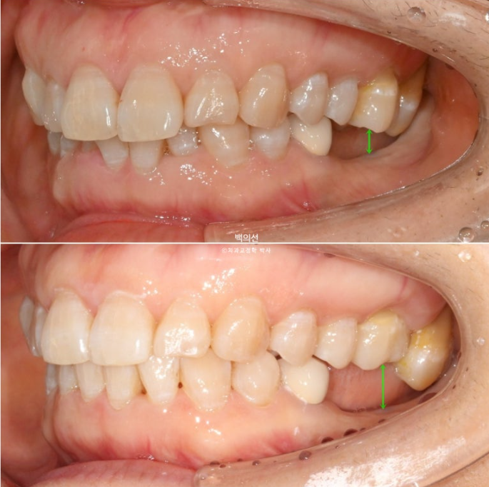 40대 인비절라인 라이트 앞니 돌출 과개교합 덧니 교정 후기 관련 이미지 1