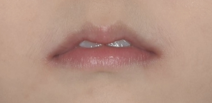 인비절라인 퍼스트, 결국 다시 교정해야 할까? 관련 이미지 5