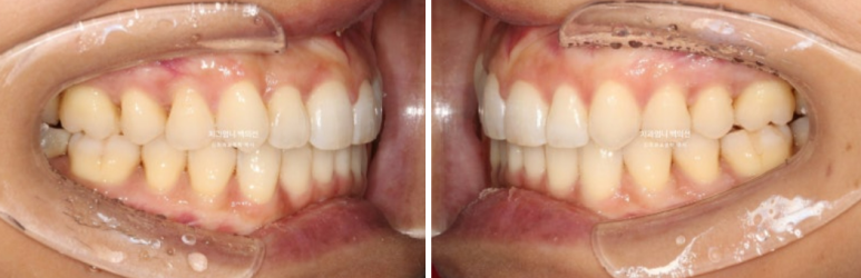 인비절라인 비발치 덧니 교정 반대교합 치료 후기 관련 이미지 14