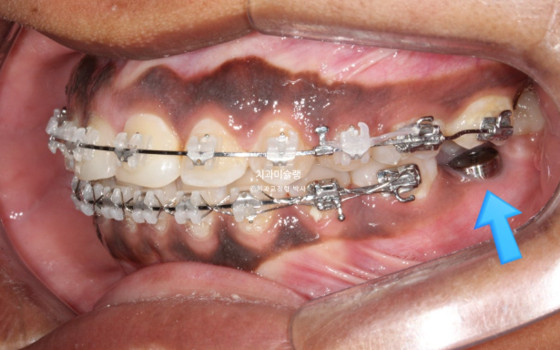 Extraction & re-orthodontics with Clippy-C, intrusion for dental implant. 관련 이미지 13