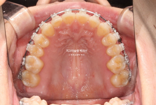 앞니 벌어짐 합죽이 방지 교정 기간 1년 4개월 관련 이미지 7