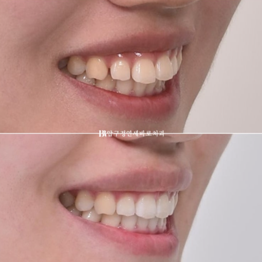 돌출입 교정 치아 벌어짐 인비절라인 투명교정 치료 관련 이미지 1