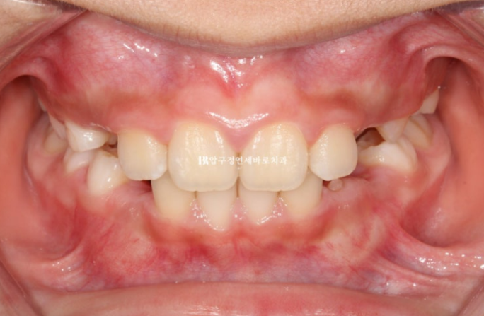 무턱교정 어린이 투명교정 인비절라인 퍼스트 교정 후기 관련 이미지 16