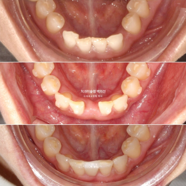 해외거주 앞니 선천적 결손 과개교합 인비절라인 라이트 브릿지 치료 관련 이미지 1