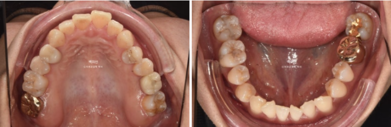 30대 비수술 비발치 주걱턱 부정교합 인비절라인 교정 관련 이미지 4