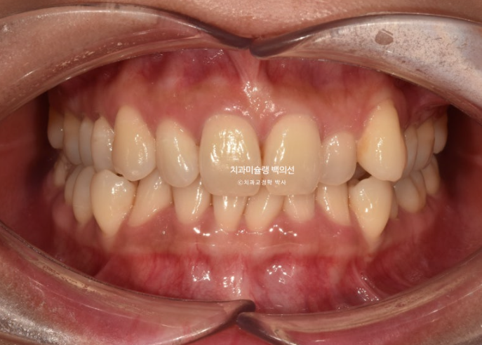 옥니 덧니 과개교합 반대교합 중심선 인비절라인 치료기간 1년 관련 이미지 2