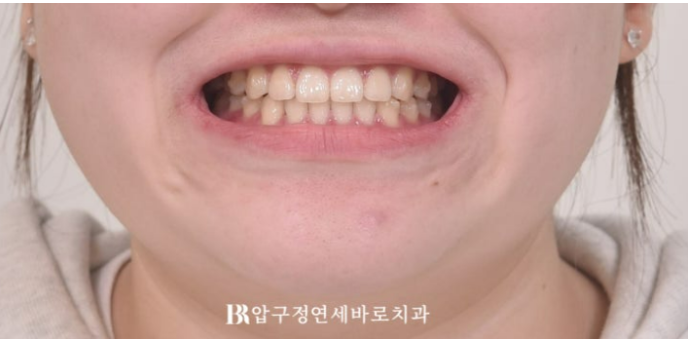 앞니 벌어짐 교정, 인비절라인이 더 잘 될까? 치아벌어짐 7개월 실제 사례 관련 이미지 7