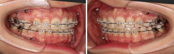 30대 돌출입 발치교정 입술부전증 치료 관련 이미지 7