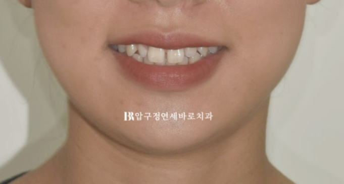 벌어진 앞니, 인비절라인과 무삭제 라미네이트로 자연스럽게 해결 관련 이미지 2