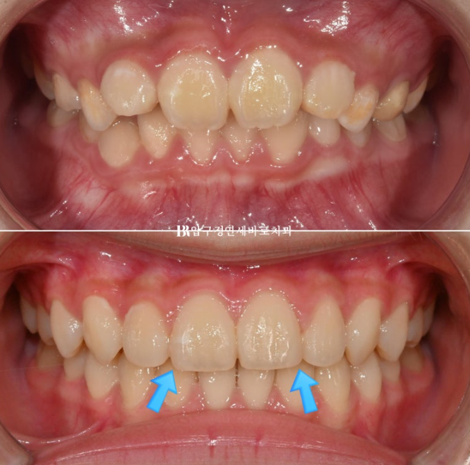 어린이교정 투명교정 인비절라인 퍼스트 후기 관련 이미지 13