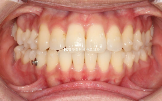 9-Month Invisalign Lite Review|Real Case Improving a Crossbite and Crooked Teeth Together image 4