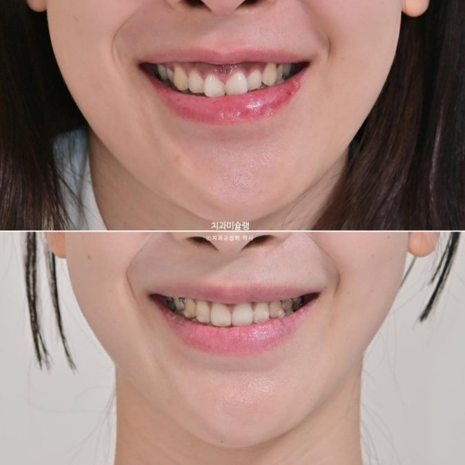 선수술 양악수술 비대칭 주걱턱 잇몸미소 치료 인비절라인 라이트 관련 이미지 11