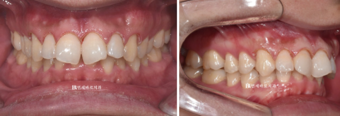 인비절라인 비추천 하는 경우? 관련 이미지 6