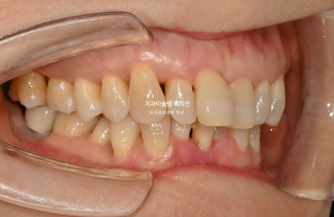 50대 치아교정 중년 발치교정 블랙트라이앵글 치료 후기 관련 이미지 3