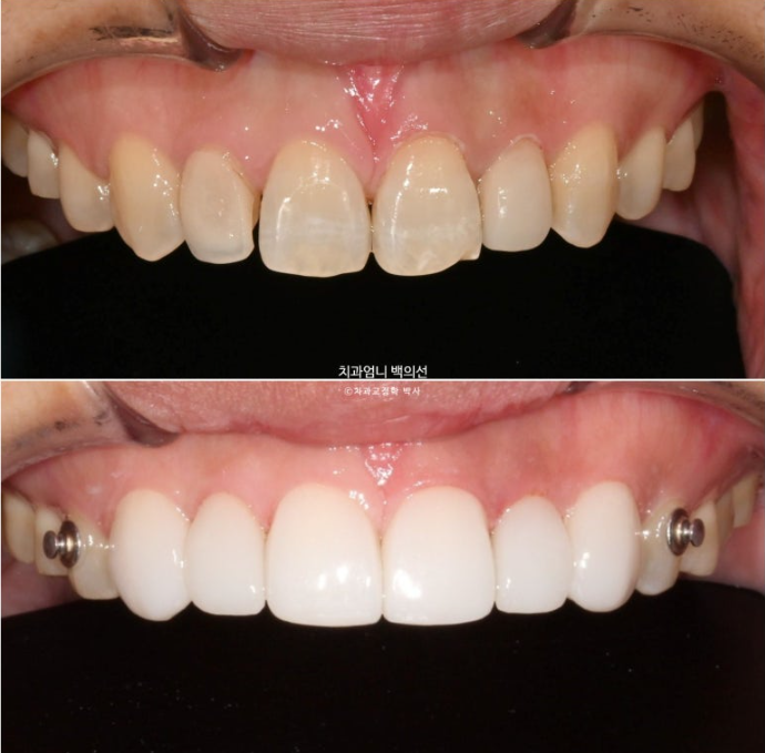 비수술 개방교합 클리피씨 30대 무삭제 라미네이트 치료기간 2년 관련 이미지 11
