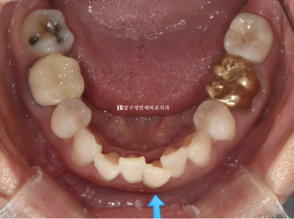 Can Invisalign Lite Work for People in Their 50s? A Real Middle-Aged Orthodontic Case Improving Butterfly Teeth and Gum Recession image 4