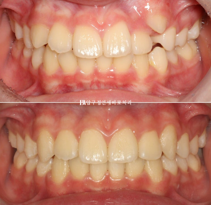덧니 인비절라인 교정 :: 강남 인비절라인 교정치과 관련 이미지 10