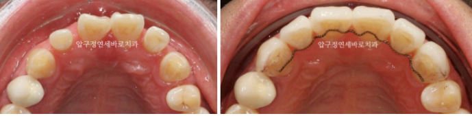 인비절라인 라이트 후 무삭제 라미네이트 치료 관련 이미지 3