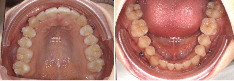 인비절라인 비발치 제2대구치 발치 사랑니 대체 교정 심한 덧니 교정 치료 관련 이미지 13
