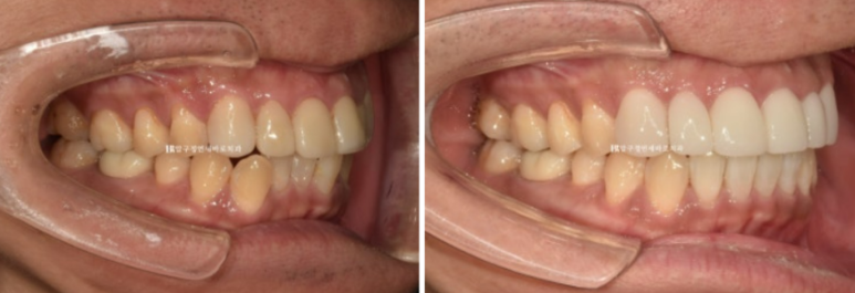 40대 중년 치아교정 인비절라인 라이트 치료기간 8개월 관련 이미지 12