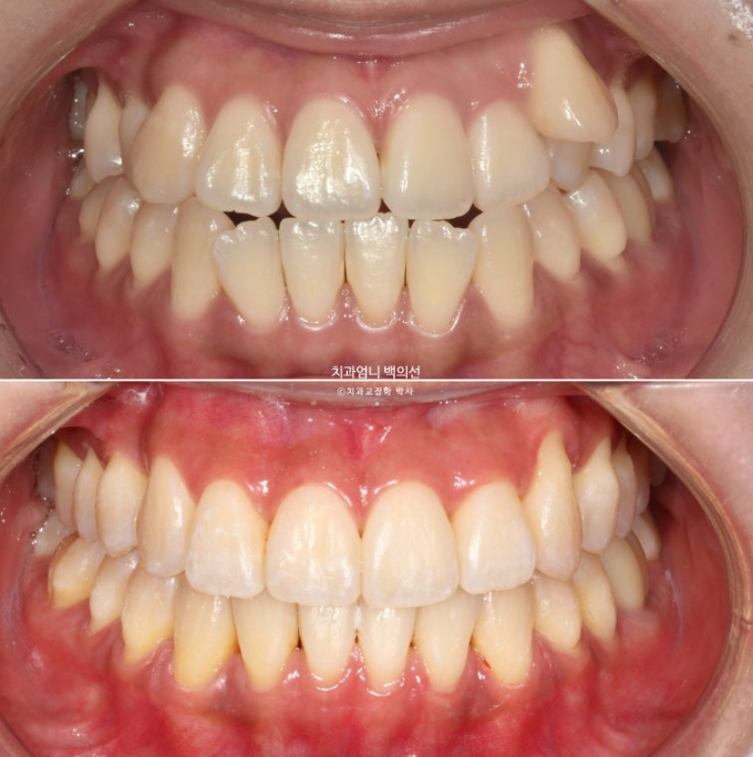 비발치 교정 덧니 인비절라인 교정 절단교합 반대교합 치료기간 1년 6개월 관련 이미지 1