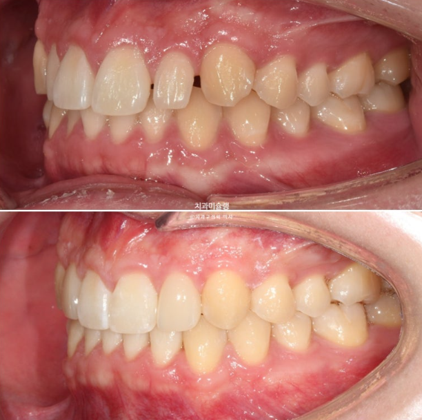 비대칭 비발치 거미스마일 잇몸미소 중심선 가위교합치료 무삭제 라미네이트 관련 이미지 26