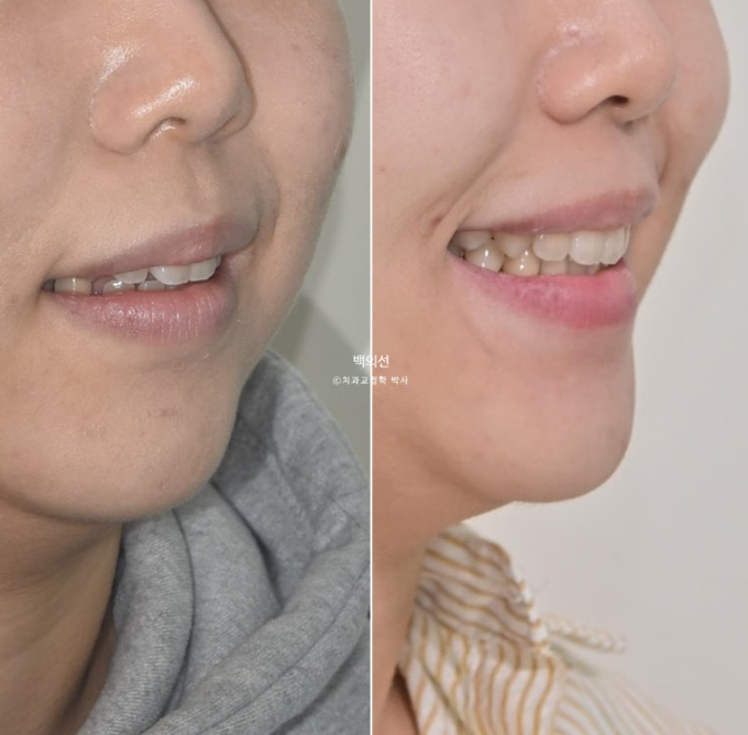 돌출입 교정 인비절라인 발치 교정 개방교합 치료 후기 관련 이미지 27