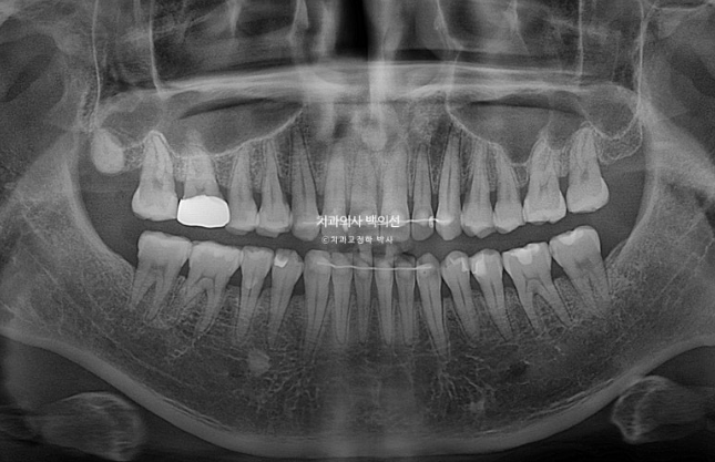 40대 인비절라인 비수술 비발치 주걱턱 비대칭 교정 관련 이미지 17