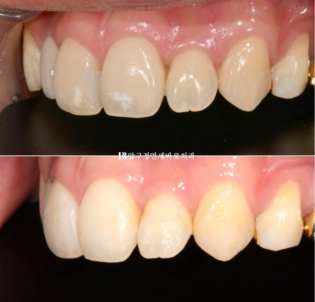 Icon White Spots on Teeth: Resin Treatment for White Spot Lesions image 9
