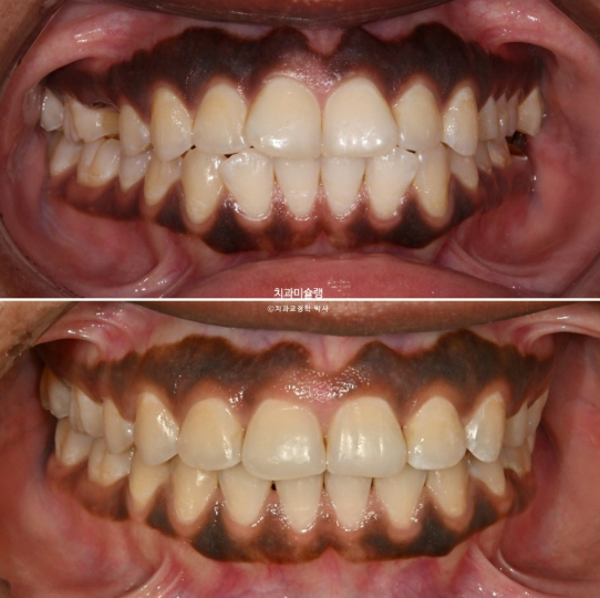 Extraction & re-orthodontics with Clippy-C, intrusion for dental implant. 관련 이미지 19