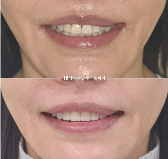 50대 라미네이트 삭제 없이 하는 법? 관련 이미지 15