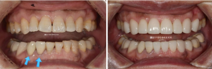 50대 라미네이트 삭제 없이 하는 법? 관련 이미지 12