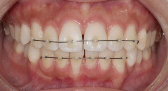 앞니부분교정 기간? MTA 미니튜브 교정 반대교합 교정 관련 이미지 5