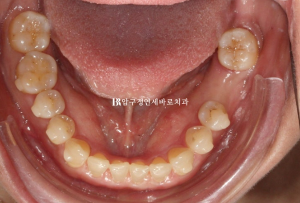 벌어진 앞니, 바로 라미네이트 하지 않은 이유｜인비절라인 후 무삭제 라미네이트 실제 사례 관련 이미지 10