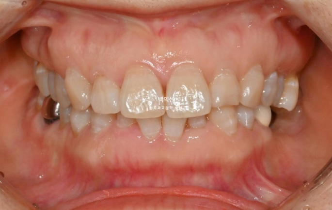 40대 인비절라인 라이트 앞니 돌출 과개교합 덧니 교정 후기 관련 이미지 2