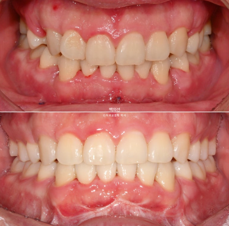 돌출입 수술 ASO + 인비절라인 라이트 후교정 치료기간 10개월 관련 이미지 17