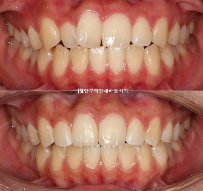 압구정 교정치과 덧니 부분교정 단기교정 후기 관련 이미지 8